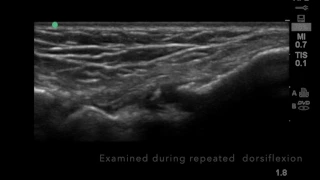 Ultrasound of anteromedial ankle impingement