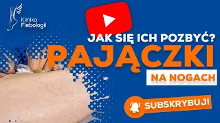 Pajączki na nogach - jak się ich pozbyć?