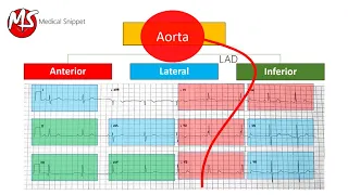 ECG localisation of the occluded coronary artery (Myocardial Infarction)