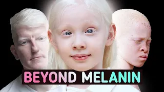 The Lack of Melanin Changes Everything