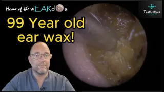 99 YEAR OLD EAR WAX! 165 #ear #earwax #earwaxremoval #earcleaning  #asmr #asmrearwax #satisfying