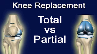 The Difference Between Total Knee Replacement And Partial Knee Replacement