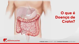 O que é Doença de Crohn? | Clínica Hepatogastro