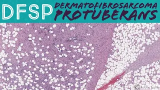 DFSP (Dermatofibrosarcoma Protuberans): 5-Minute Pathology Pearls