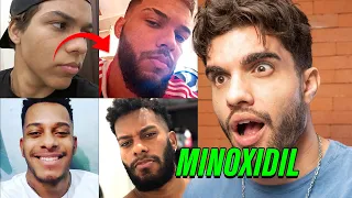 Evolução dos INSCRITOS - Barba ANTES E DEPOIS 🧔 Minoxidil