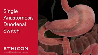 Loop Duodenal Switch Procedure Animation