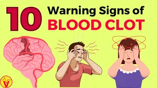 10 WARNING Signs of BLOOD CLOT | Blood Clot Signs |  VisitJoy