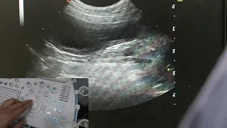 Optimising your ultrasound image
