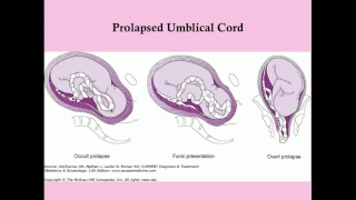 Obstetric Complications of Labor - CRASH! Medical Review Series