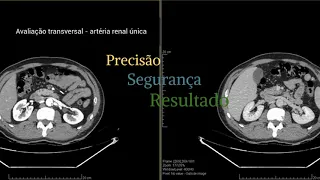 Avaliação do doador renal