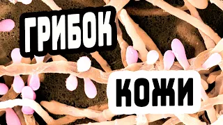 КАК ИЗБАВИТЬСЯ ОТ ГРИБКА НА КОЖЕ / ЛЕЧЕНИЕ ГРИБКА НА КОЖЕ / ГРИБОК КОЖИ