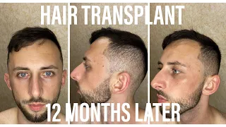 12  МЕСЯЦЕВ ПОСЛЕ ПЕРЕСАДКИ ВОЛОС В ТУРЦИИ / Пересадка волос. FUE Hair Transplant / ПОЛНЫЙ РЕЗУЛЬТАТ