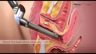 FemiLift Laser Vaginal Tightening