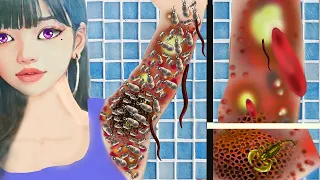 ASMR Underarm Worms & Pustule Removal |  Hair Removal Animation | Relaxing Treatment"Unmute Asmr