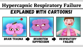 Hypercapnic (type 2) respiratory failure explained with cartoons!