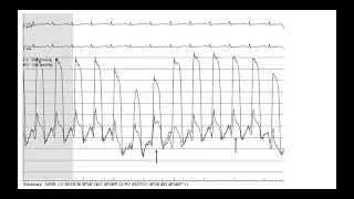 Hemodynamics 4:  Constrictive pericarditis, case studies- Elias Hanna, Univ Iowa