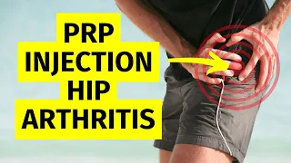 Platelet Rich Plasma (PRP) Injections for Hip Arthritis
