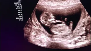 Ultrasound for pregnancy /13 weeks baby dancing in womb 💃  /shorts/Dr Shikha Agarwal