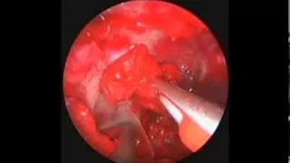 Perfused Cadaveric Model for Simulation of Carotid Artery Injury During Endoscopic Endonasal Surgery