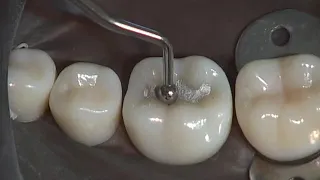 Class I Amalgam Preparation & Restoration | Operative Dentistry