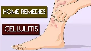 Home Remedies for Cellulitis Skin Infection