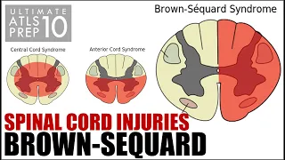 Ultimate ATLS 10: Brown-Sequard Syndrome | Spine & Spinal Cord Trauma