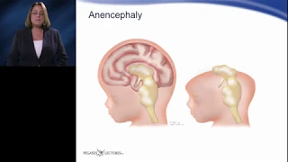 Quick Concepts - Acrania vs. Anencephaly