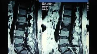 Spine Lecture: Kyphoplasty