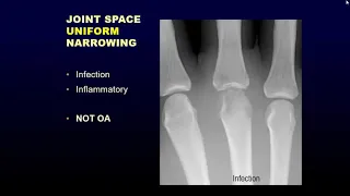 Arthritis I - Erosive arthritis