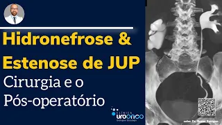 Cirurgia Robótica para Estenose de JUP com Hidronefrose (Rim dilatado).  Operação e Recuperação.