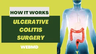 How Ulcerative Colitis Surgery Works | 3D Medical Animation | Pixeldust Studios