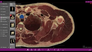 Anatomia radiológica  - Ombro