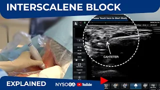 Ultrasound-Guided Continuous Interscalene Block - Regional anesthesia Crash course with Dr. Hadzic