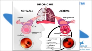 Asthma Canada Patient Education - Severe Asthma and Biologic Treatments