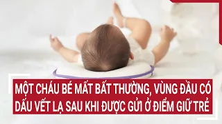 Một cháu bé mất bất thường, vùng đầu có dấu vết lạ sau khi được gửi ở điểm giữ trẻ