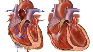 Congestive Heart Failure