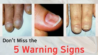 Don't Miss 5 Warning Signs | What Your Nails Could Be Telling You About Your Health
