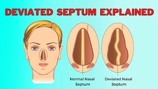 What Causes A Deviated Nasal Septum? A Surprising Reason