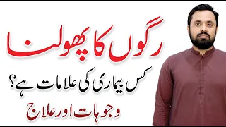 Varicose Vein Treatment - Causes & Symptoms In Urdu/Hindi | By Dr. Idrees Gondal