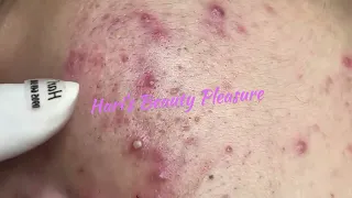 Pimples/Whiteheads Removal with Hari's -  Satisfying