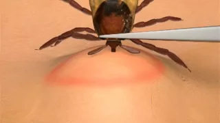 How To Remove A Tick