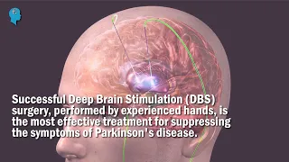 Deep Brain Stimulation(DBS) surgery on our patient was successfully performed in experienced hands