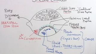 High Yield Topic: Vernal Kerato Conjunctivitis & Trachoma