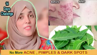 14 Days Challenge - No More ACNE, Pimples & Dark Spots + Get FAIR & Flawless Skin