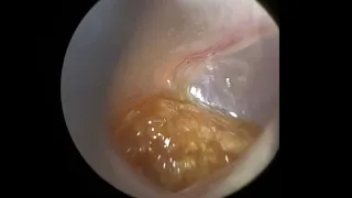 63 - Soft Impacted Ear Wax on Eardrum Removal with WAXscope®️