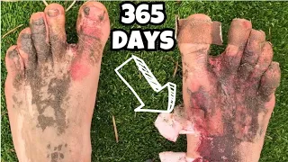 365 DAYS in Barefoot Shoes.... My Feet Are Broken, The TRUTH Why I Hate Them !