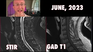 Scary Spinal MRI: Multiple Sclerosis Spinal Cord