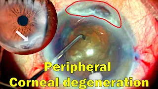 Cataract Surgery in an eye with Peripheral Corneal Thinning (Terien's)- Concerns & Strategies.