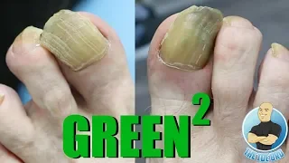 FUNGUS HUMONGUS - TRIMMING FUNGAL TOENAILS