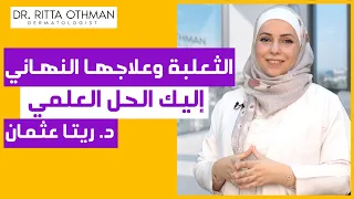 علاج الثعلبة بشكل نهائي 😍 👌| العلاجات الصحيحة للثعلبة